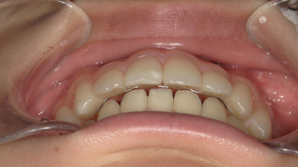 出っ歯　口ゴボ　八重歯　受け口　すきっ歯　　オープンバイト 10