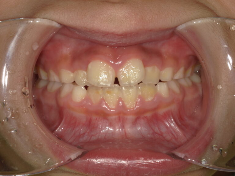 旭川駅前あしたばデンタルクリニック_2026_02_27_小児矯正