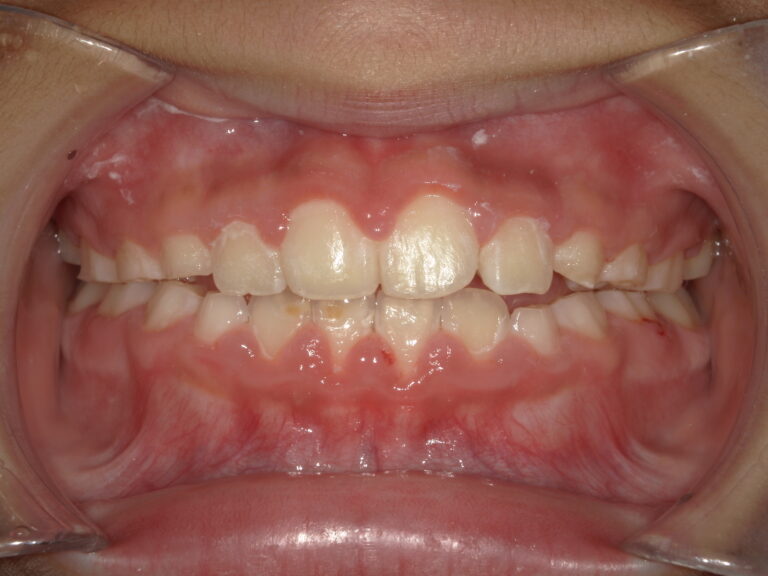 旭川駅前あしたばデンタルクリニック_2026_02_27_小児矯正